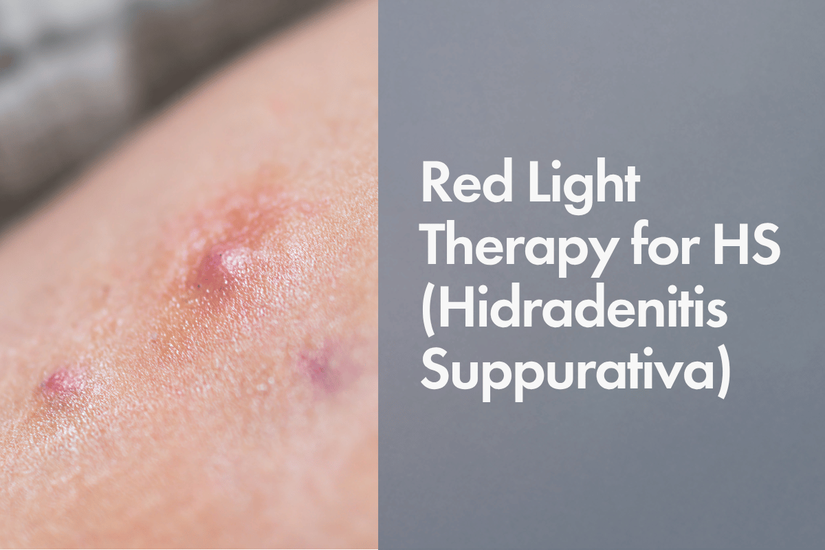 Close-up image of inflamed, red skin bumps commonly associated with Hidradenitis Suppurativa. On the right side, there is bold text that reads: “Red Light Therapy for HS (Hidradenitis Suppurativa)” on a grey background.