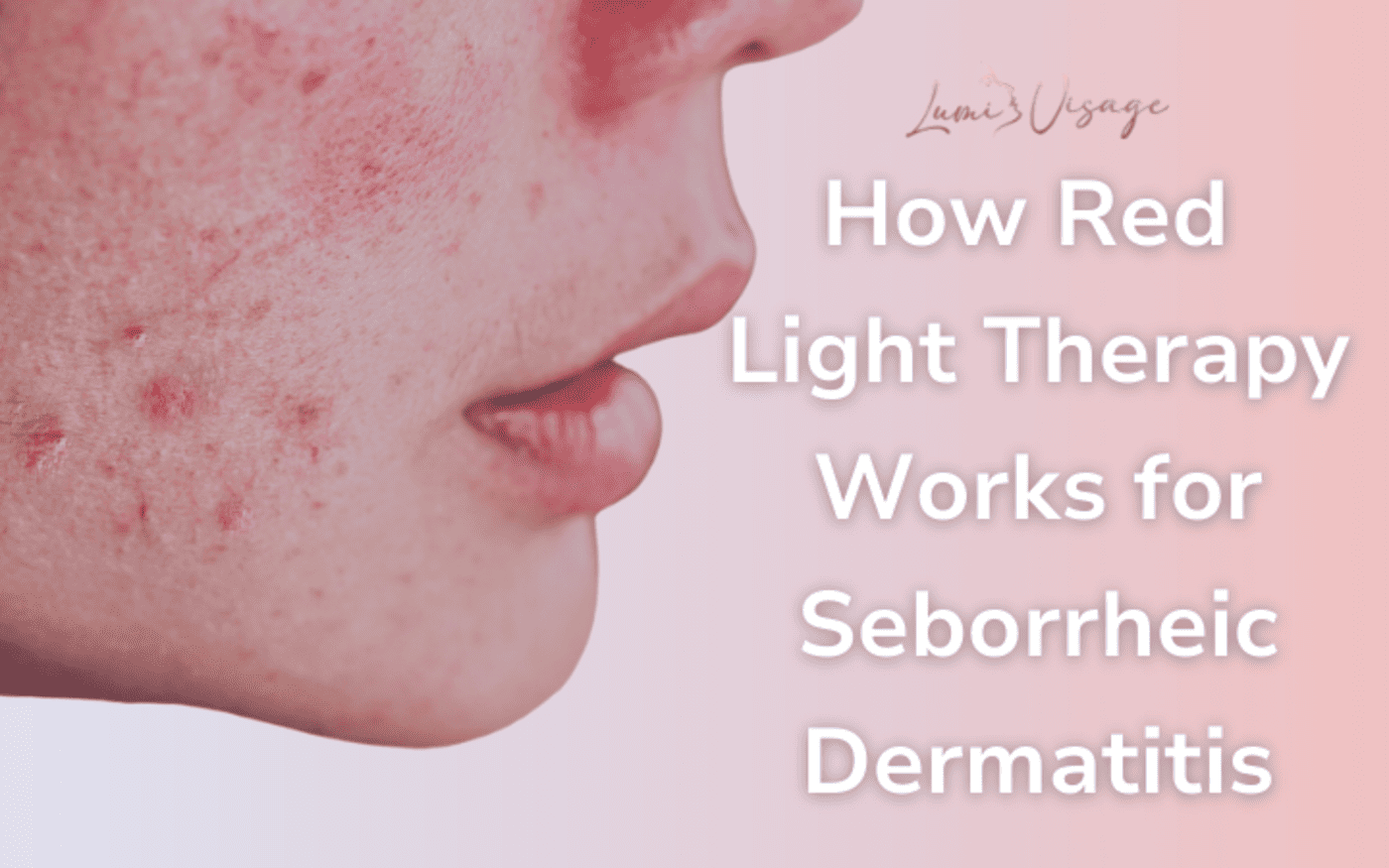 How Red Light Therapy Works for Seborrheic Dermatitis