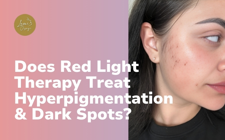 Does Red Light Therapy Treat Hyperpigmentation & Dark Spots