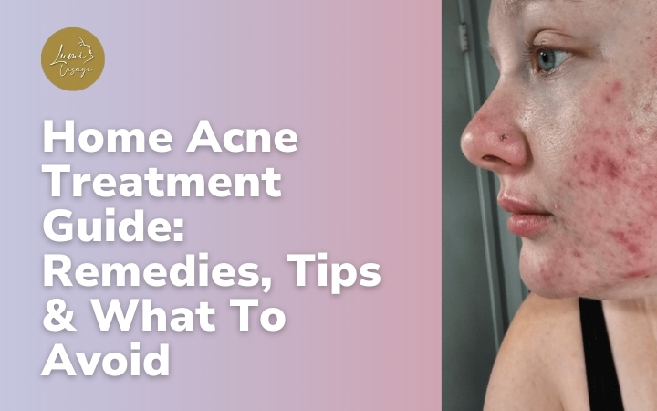 Home Acne Treatment Guide Remedies, Tips & What To Avoid