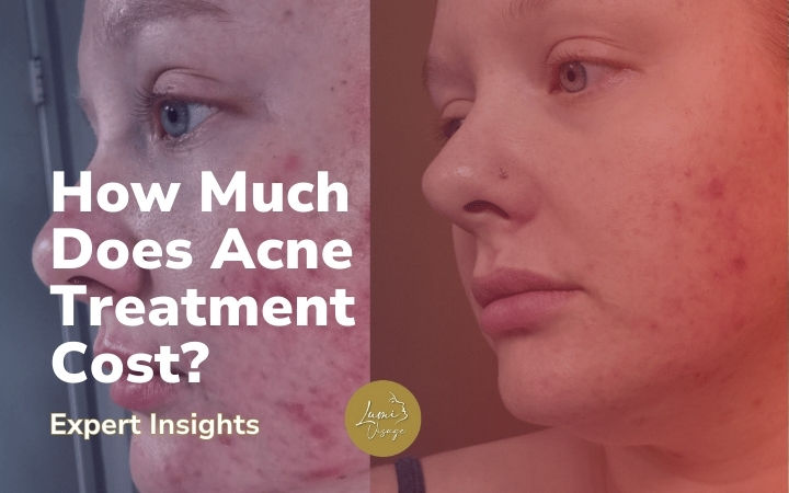 How Much Does Acne Treatment Cost