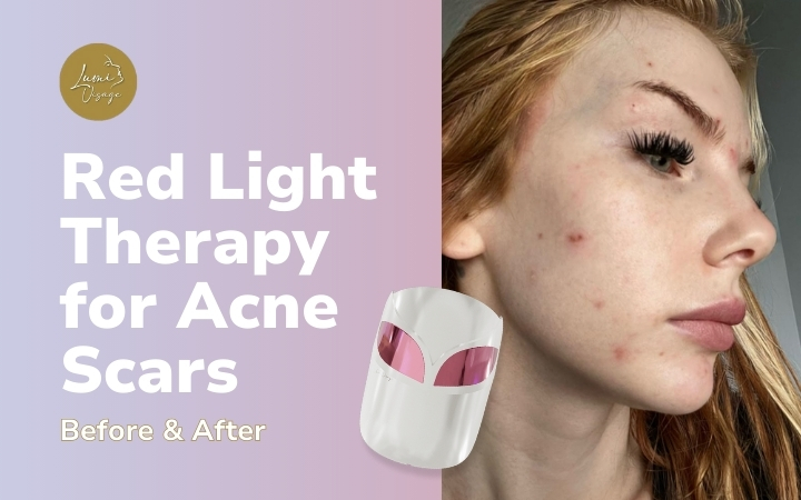 Red Light Therapy for Acne Scars Before & After