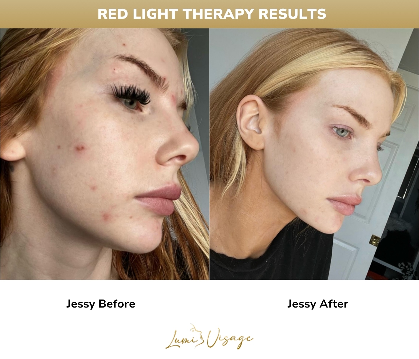 Red Light Therapy results
