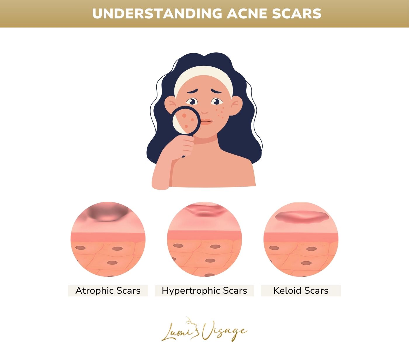 understanding acne scars