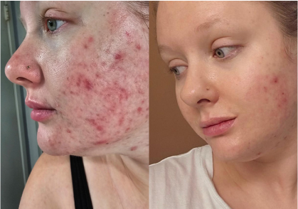 Acne Solution Image