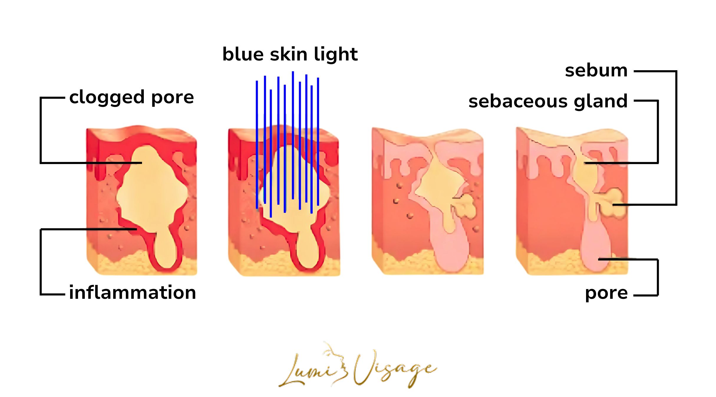 blue light for acne
