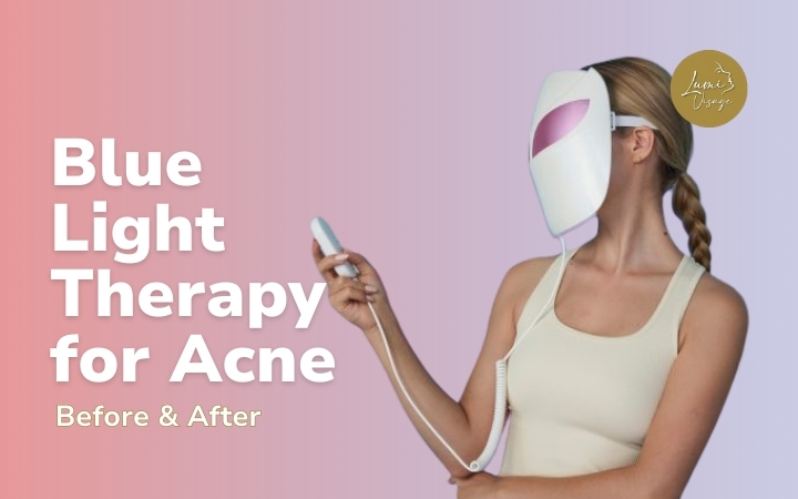 blue light therapy for acne