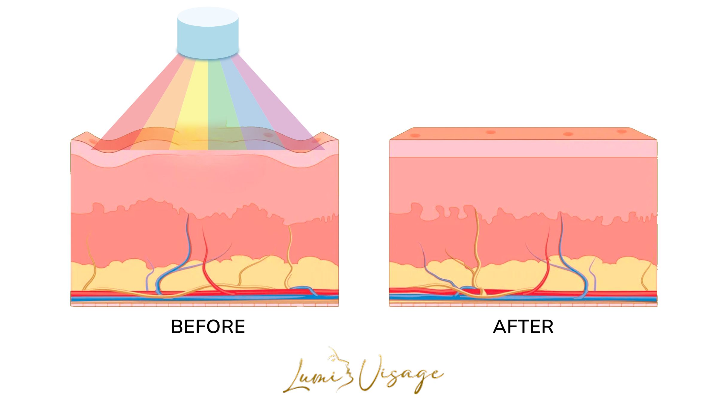 does red light therapy work for wrinkles