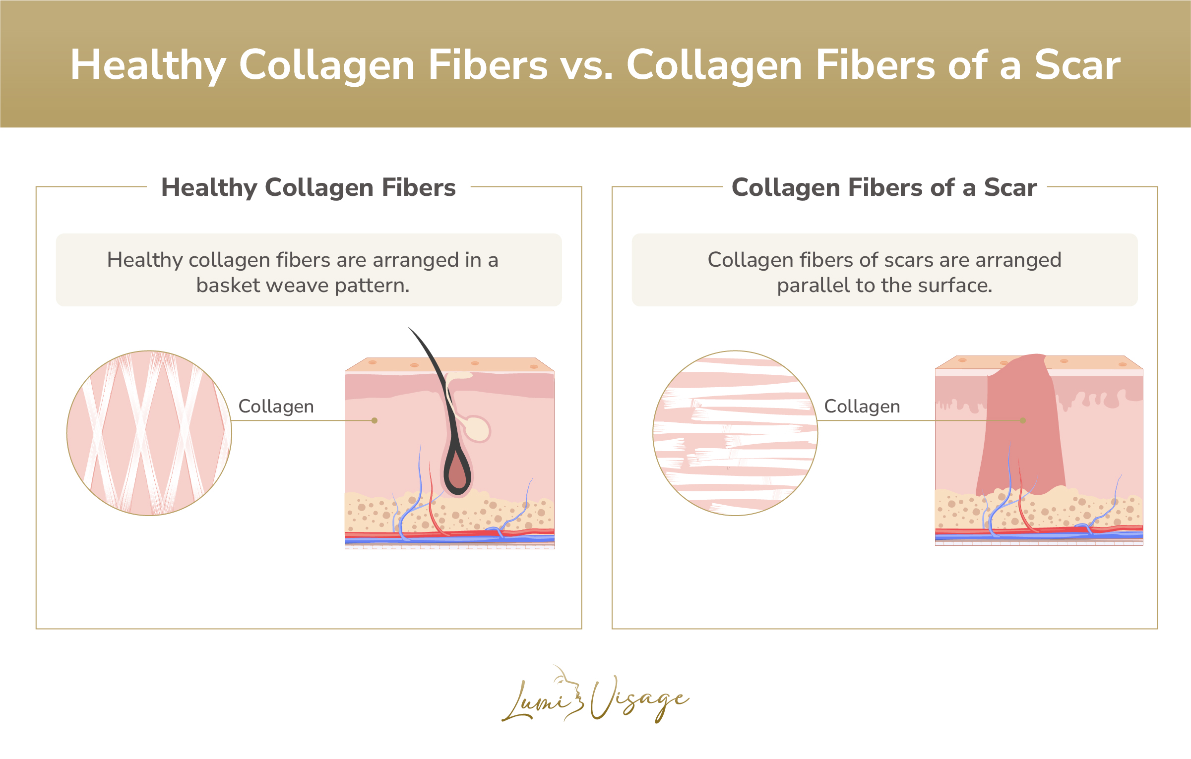 healthy collagen fibers vs collagen fibers of a scar