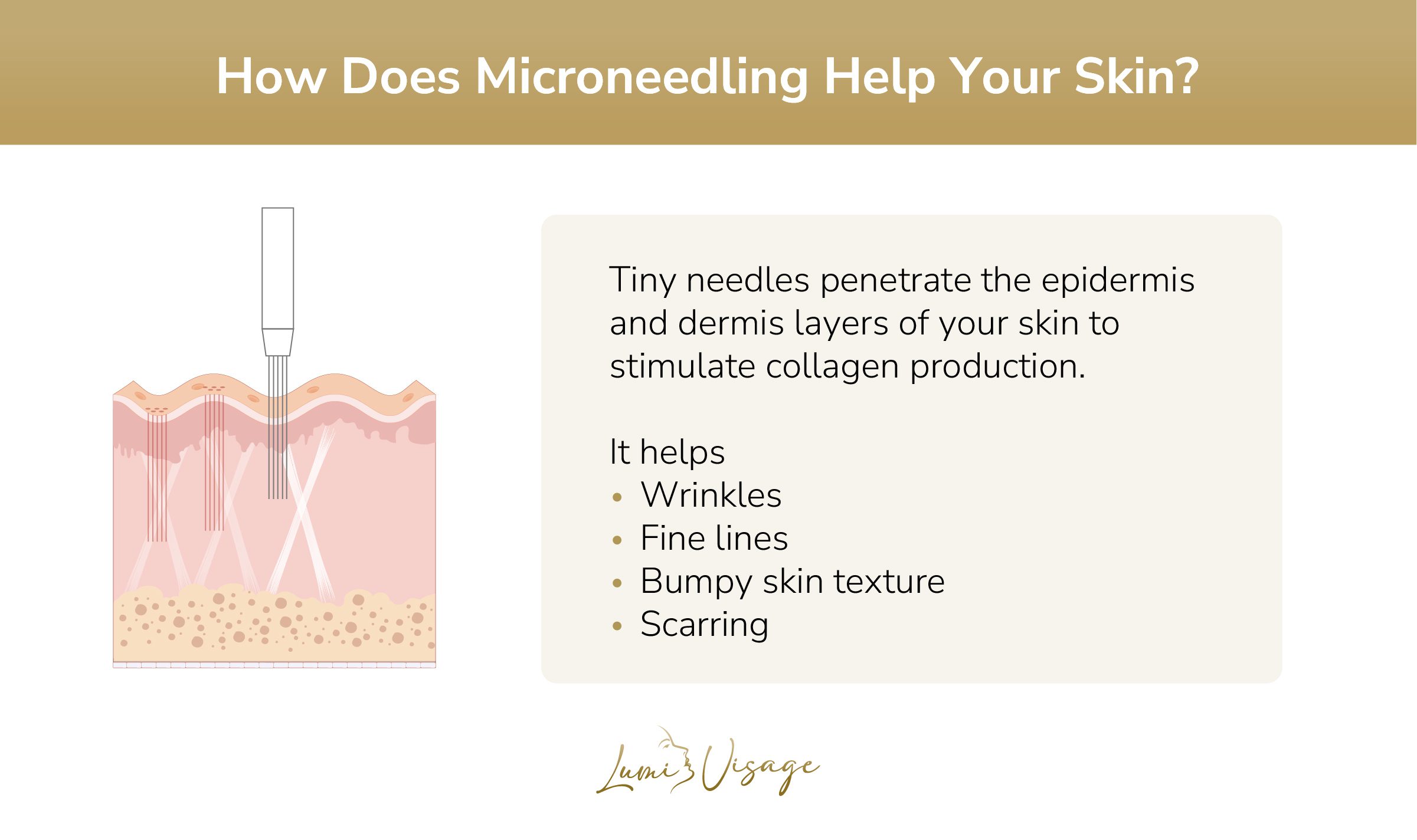 how does microneedling help your skin